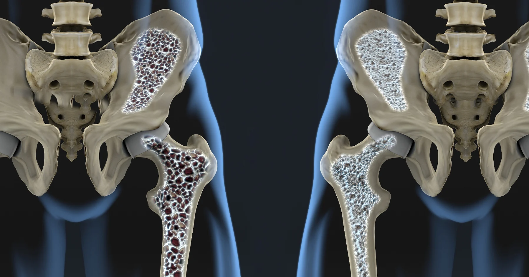 Diabetes and Osteoporosis: A Growing Concern